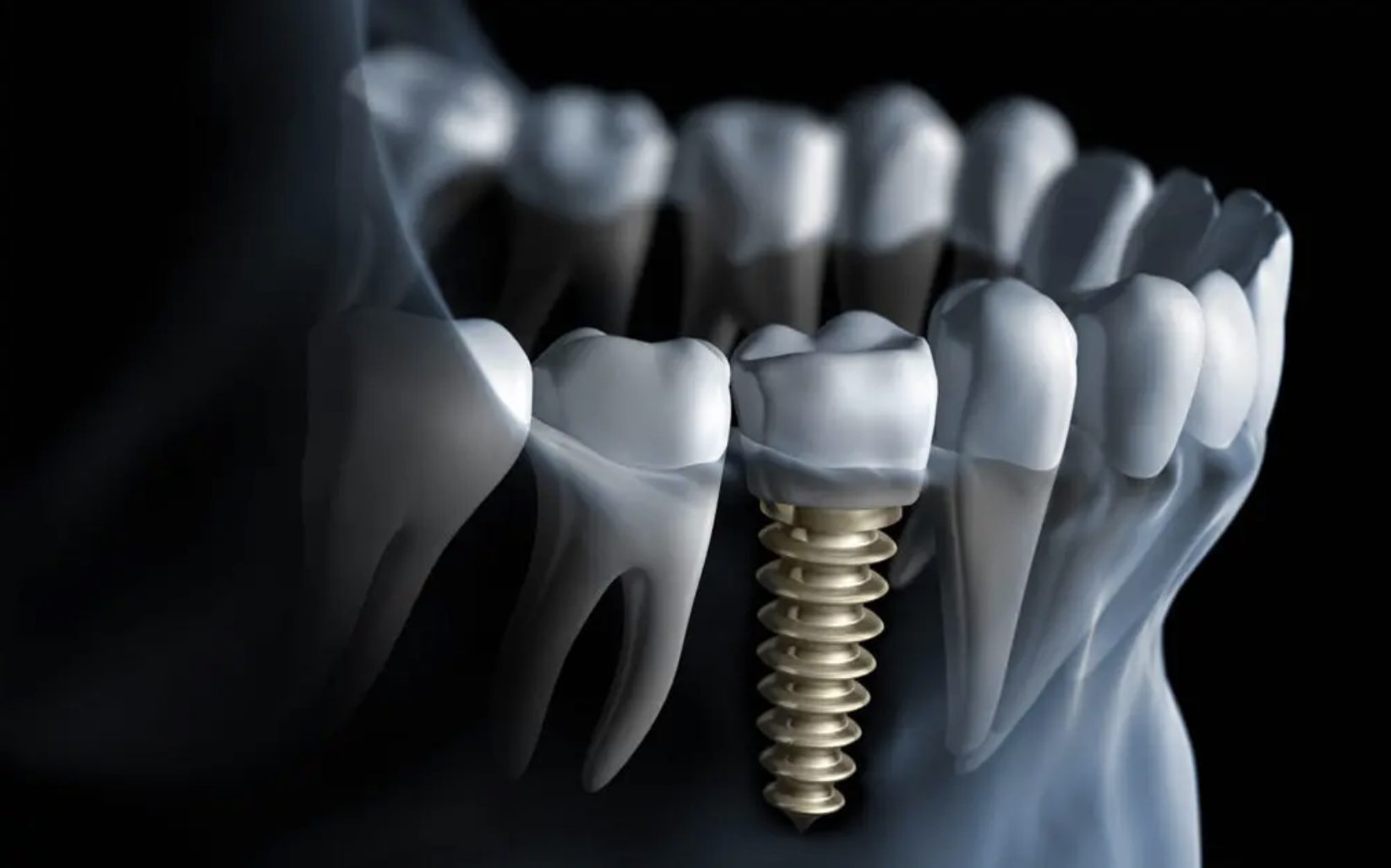How Can You Keep Your Implant Clean and Hygienic?
