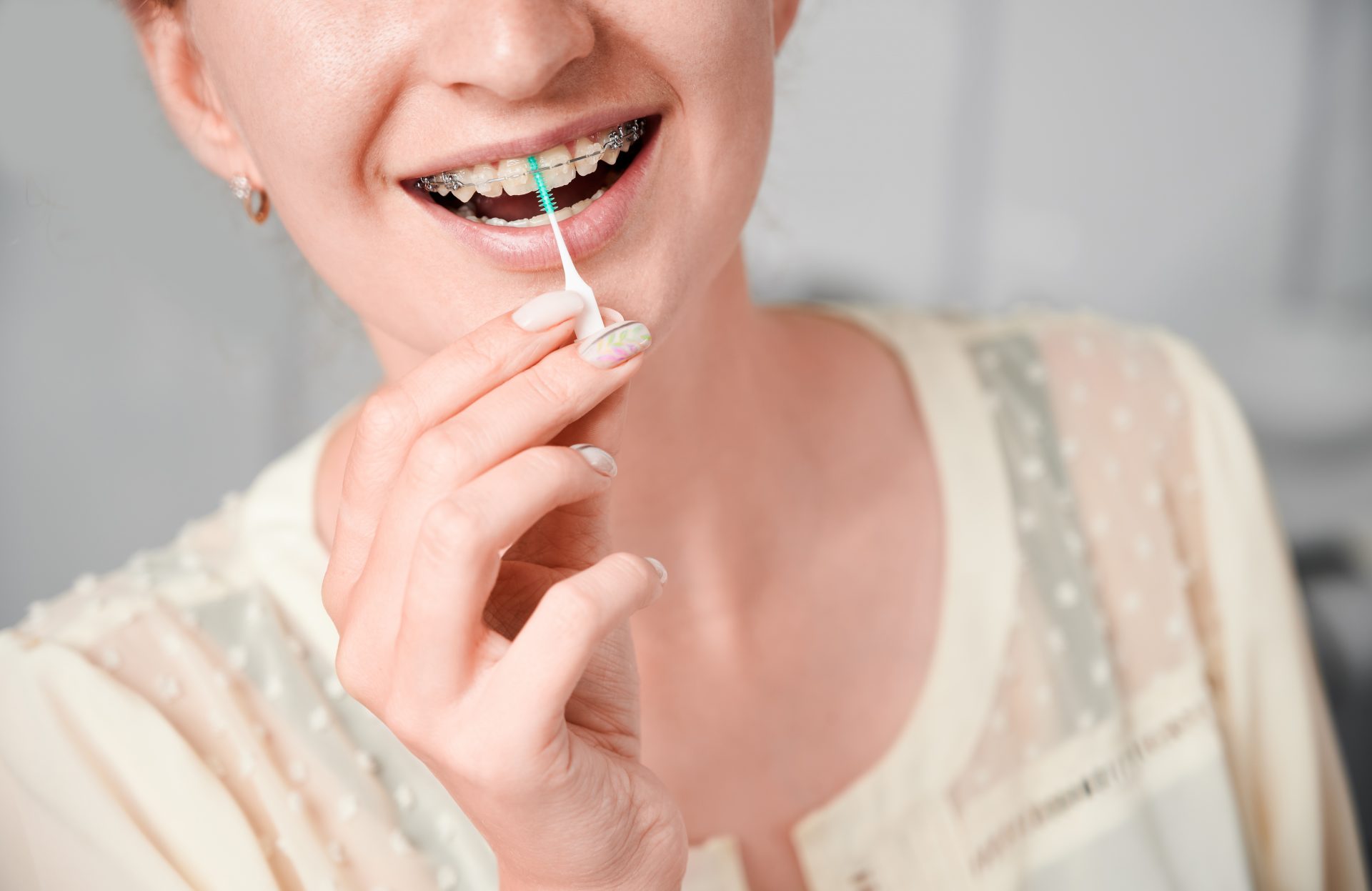 Diş Teli Tedavisinde Diş Lekelerini Önlemek için 3 İpucu!