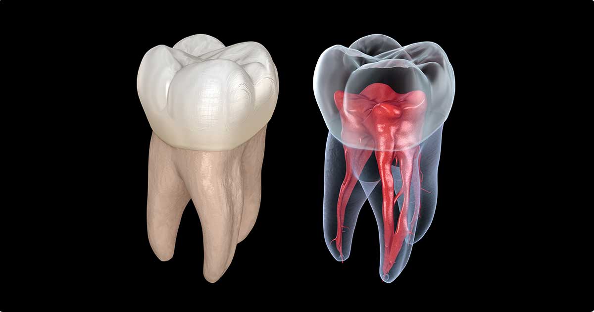 Diş Kökü Enfeksiyonunuz Tedavi Edilmezse Ne Olur?
