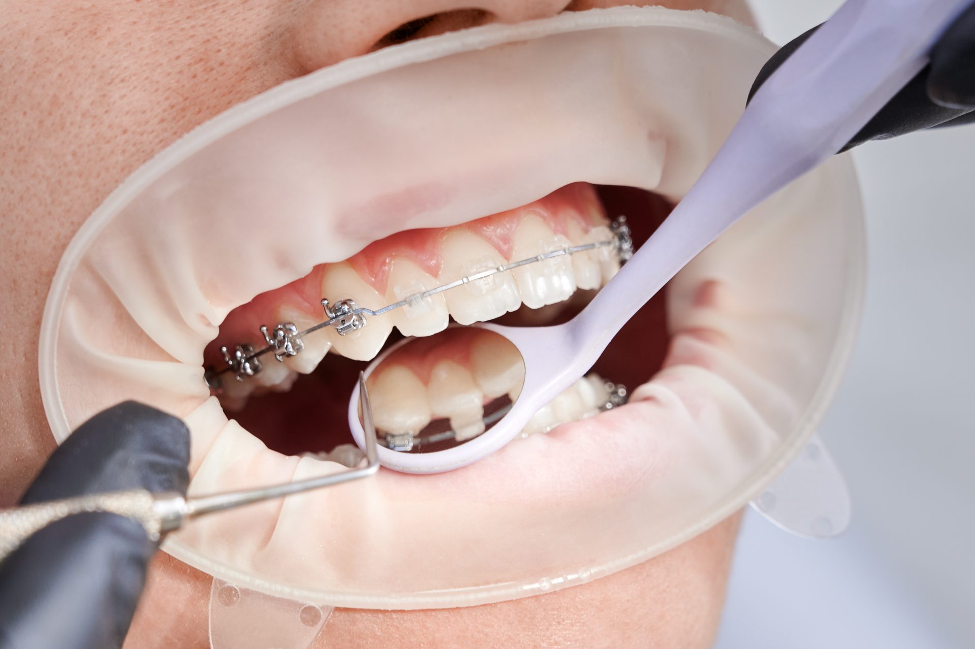 Can You Whiten Your Teeth While Wearing Braces?