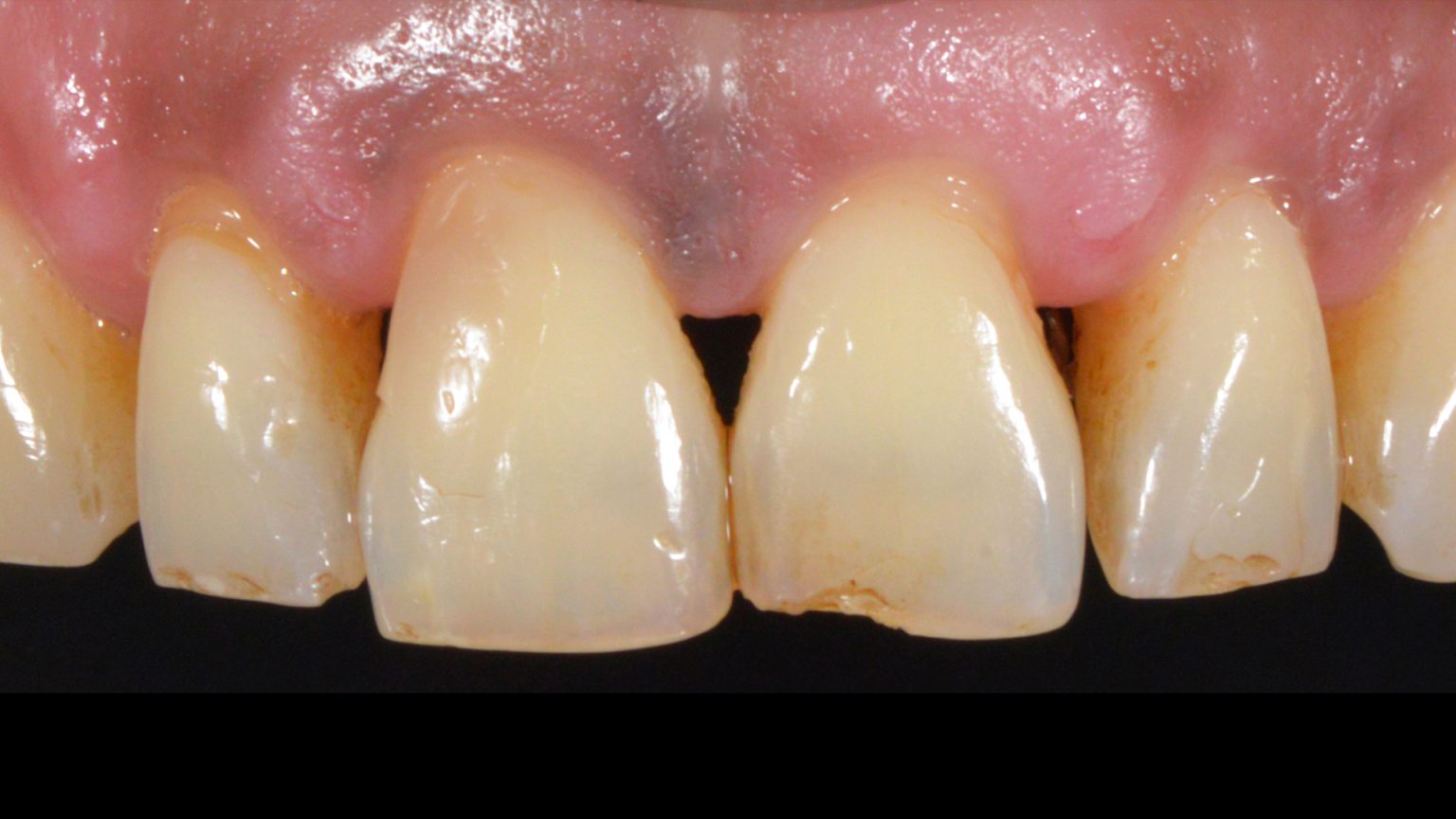 Do You Have Black Triangles Between Your Teeth? Dent Suadiye