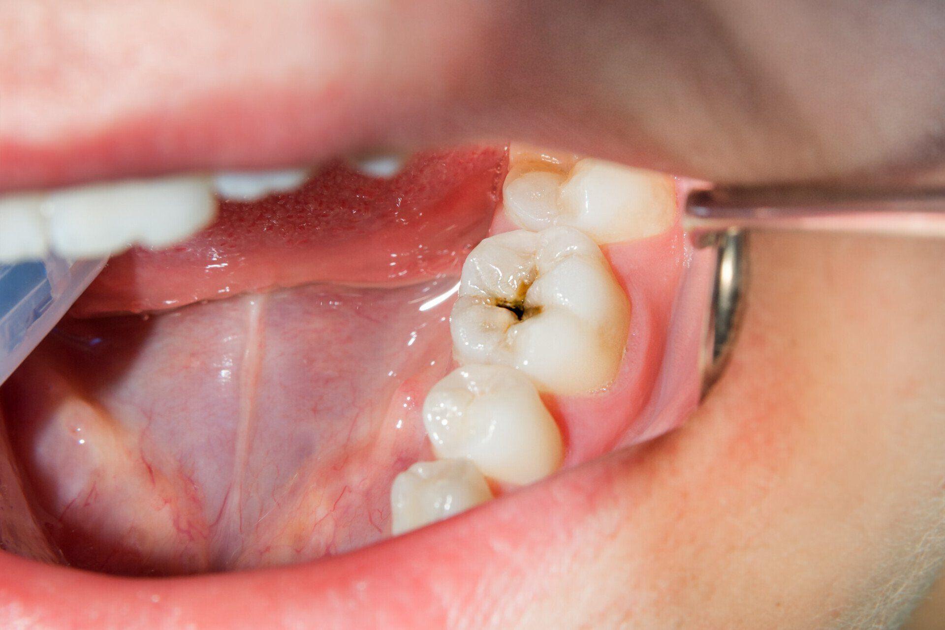 What is Hidden Tooth Decay?